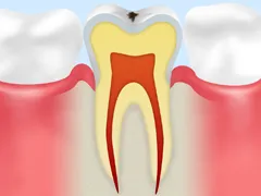 C0むし歯