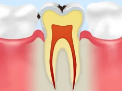 C1むし歯