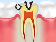 C2むし歯