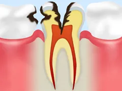 C3むし歯
