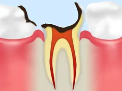 C4むし歯