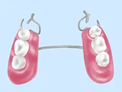 部分入れ歯